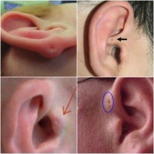 disable alien implants in ear